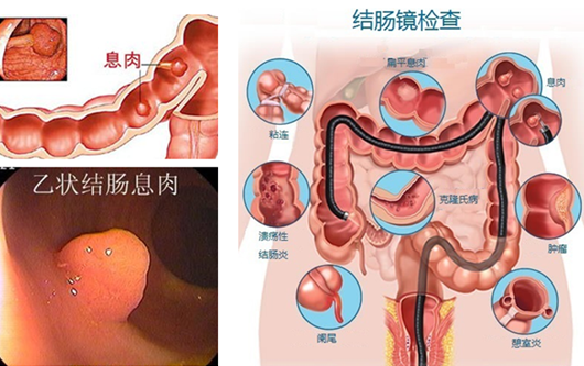 萎縮性胃炎真的“很?chē)樔恕?？看完這“七個(gè)事實(shí)”你就明白了